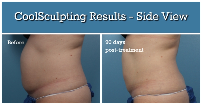 CoolSculpting Results - Side View