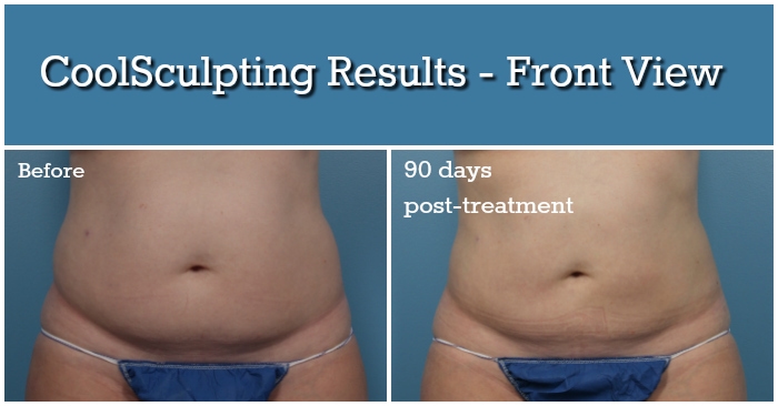 CoolSculpting Results - Front View